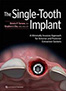 single-tooth-implant-books